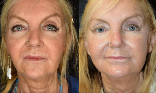 thread lift facial tightening before after mississauga oakville
